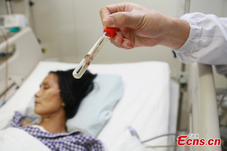 6cm-long toothpick removed from Hunan woman's heart