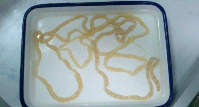 Chinese woman discovers 8ft-long tapeworm living inside her