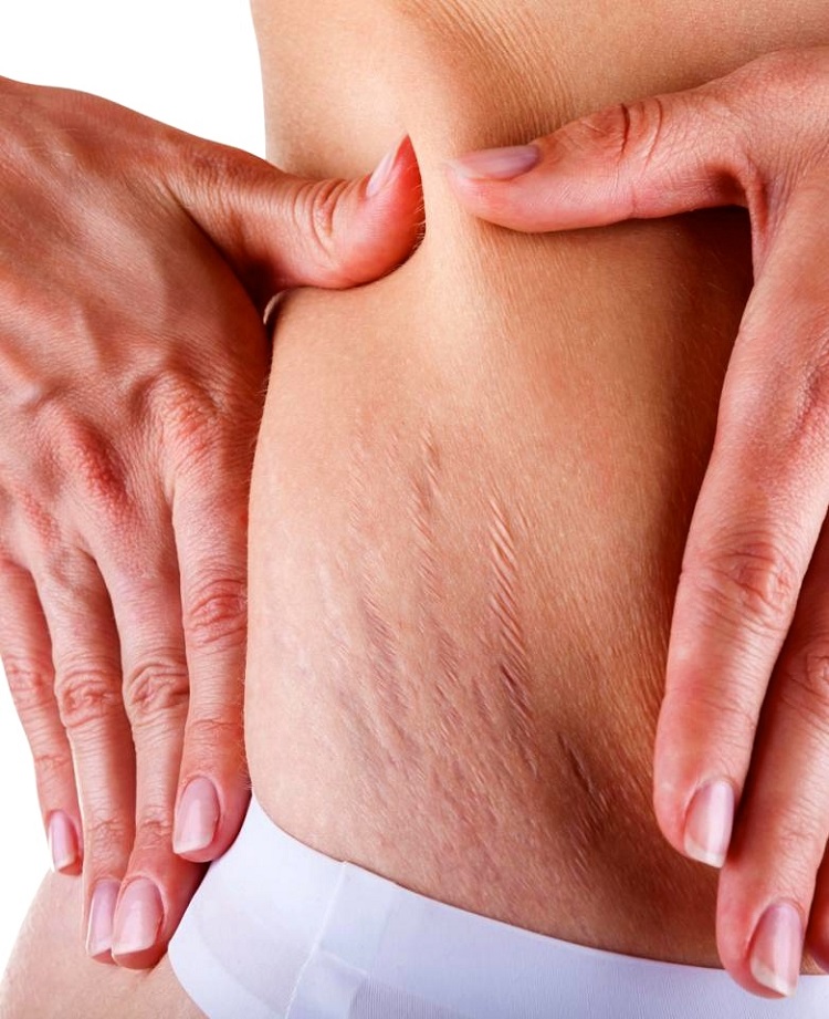 Ask the doc: The long and the short of stretch marks